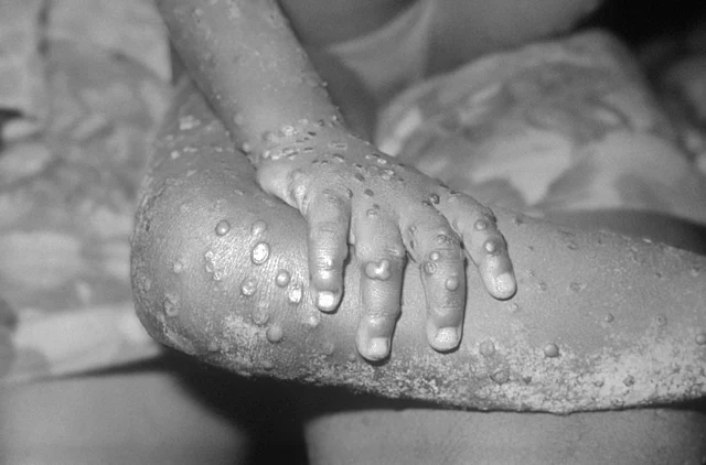 La UE no recomienda la vacunación masiva contra la mpox
